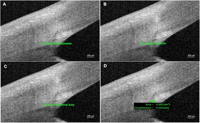 Fourier-Domain Optical Coherence Tomographic Assessment of Changes in the Schlemm’s Canal of Nonglaucomatous Subjects After Keratoplasty